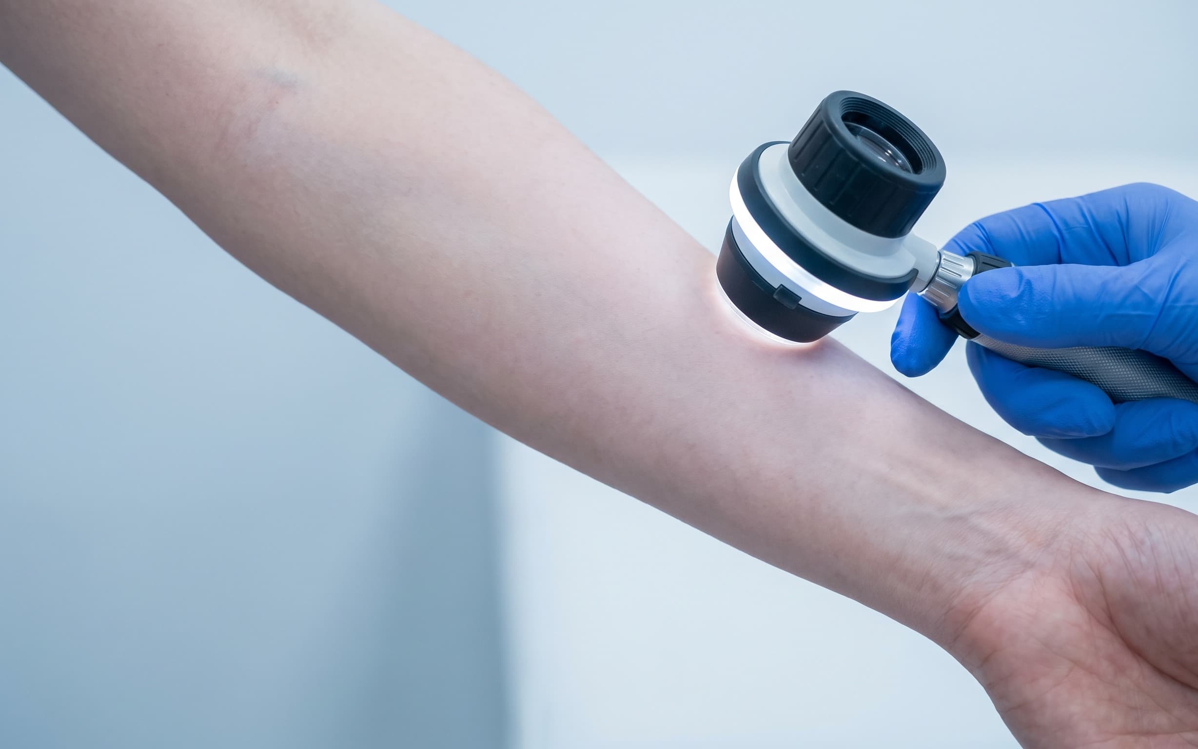 Dermatoscope skin examination
