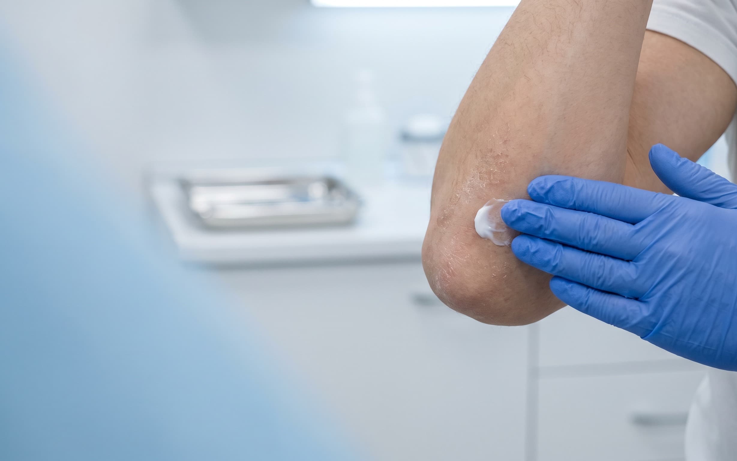 Skin assessment for a psoriasis protocol